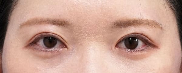眉下切開、二重全切開・挙筋前転（眼瞼下垂）　６ヶ月後のAfterの写真