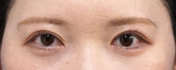 眉下切開、二重全切開・挙筋前転（眼瞼下垂）　６ヶ月後のAfterの写真