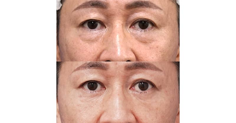 目袋が目立つ男性のクマ治療｜目の下脂肪取り・コンデンス脂肪注入　３ヶ月後