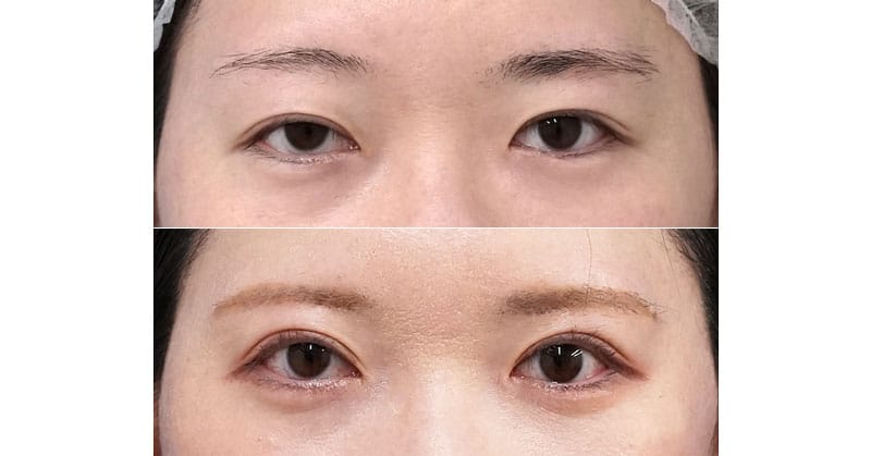 この目は二重手術だけでは治りません｜眉下切開、二重全切開・挙筋前転（眼瞼下垂）　６ヶ月後