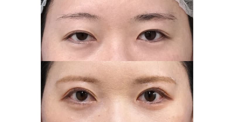 この目は二重手術だけでは治りません｜眉下切開、二重全切開・挙筋前転（眼瞼下垂）　６ヶ月後