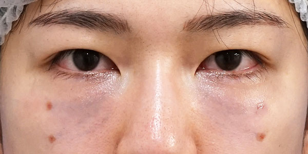目の下脂肪取り・脂肪注入　手術直後