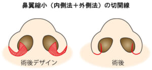 鼻翼縮小(内側法+外側法)切開線