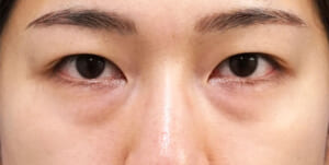 目の下脂肪取り・脂肪注入　手術前
