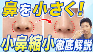 【鼻整形】大きく目立つ鼻を小さく!小鼻縮小の最新症例を7人ご紹介します