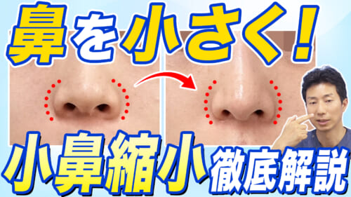 【鼻整形】大きく目立つ鼻を小さく！小鼻縮小の2026年最新症例を7人ご紹介します