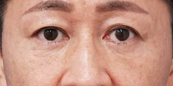目の下脂肪取り・脂肪注入　３ヶ月後
