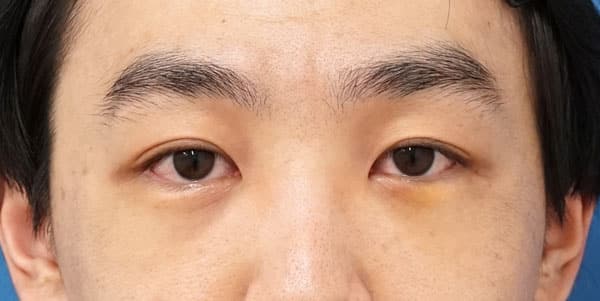 目の下くま取り（裏ハムラ法）　１週間後のAfterの写真