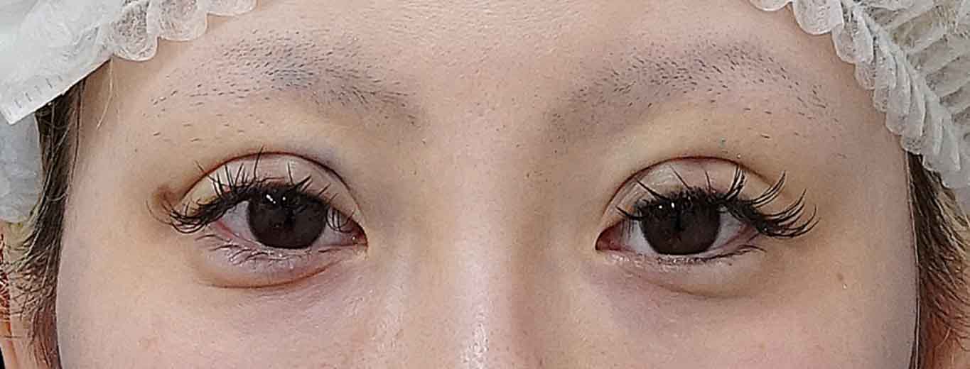 二重埋没（連結二点表止め もとびアイライト）　術直後のAfterの写真