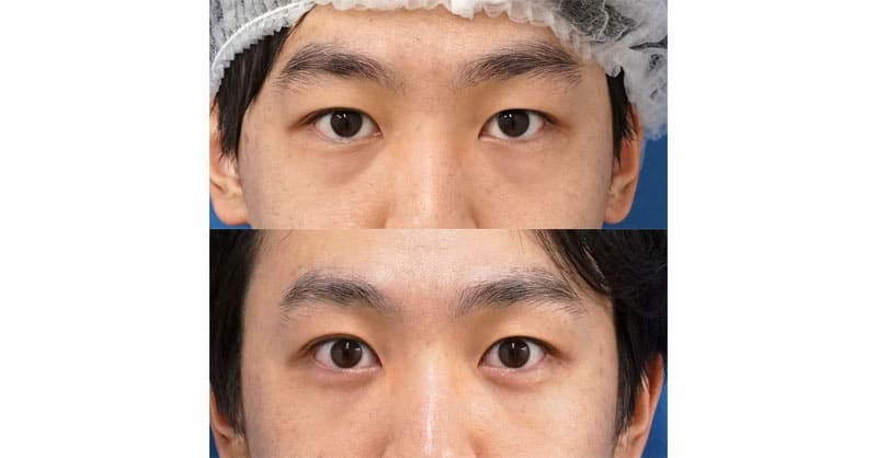 裏ハムラで目元すっきり、涙袋くっきり　１週間後～３ヶ月後