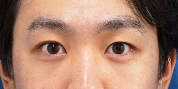 目の下くま取り（裏ハムラ法） ３ヶ月後のAfterの写真