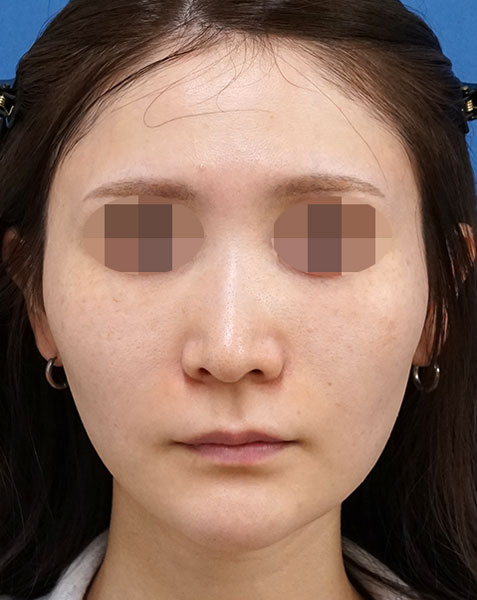 目の下くまとり手術（脂肪取り・脂肪注入）、脂肪注入（ほうれい線）　３ヶ月後