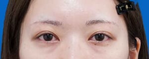 眉下切開 術後6か月