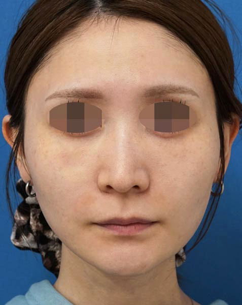 目の下脂肪とり、コンデンス脂肪注入（目の下・ほうれい線）　１か月後のAfterの写真