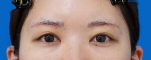 眉下切開 術後1週間