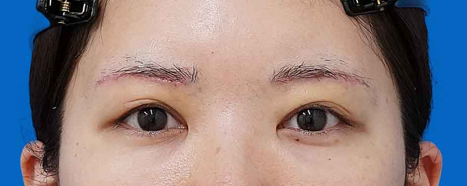 眉下切開 術後1週間（抜糸直後）のAfterの写真