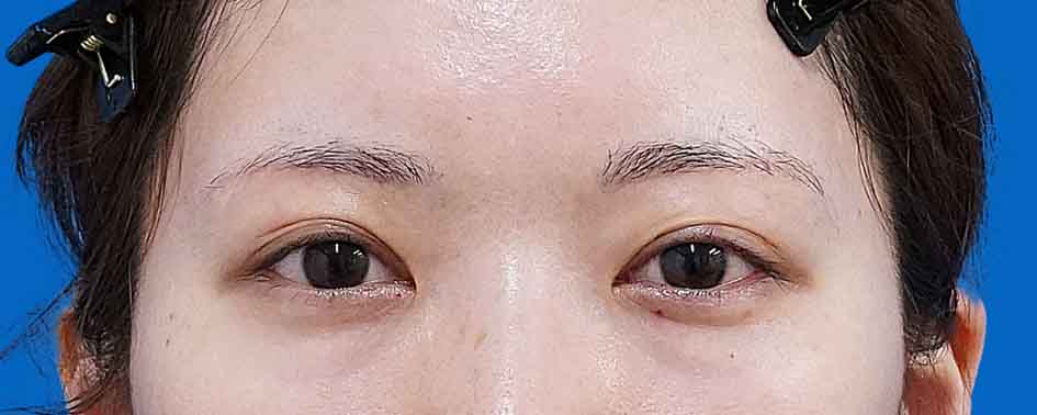 眉下切開 術後3か月のAfterの写真