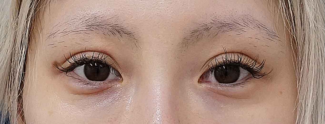 二重埋没（連結二点表止め もとびアイライト） 術後1週間のAfterの写真