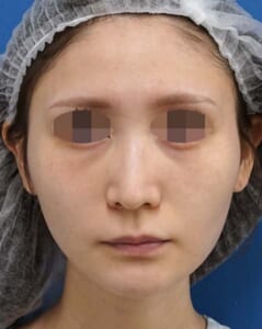 目の下くまとり手術（脂肪取り・脂肪注入）、脂肪注入（ほうれい線）　手術前