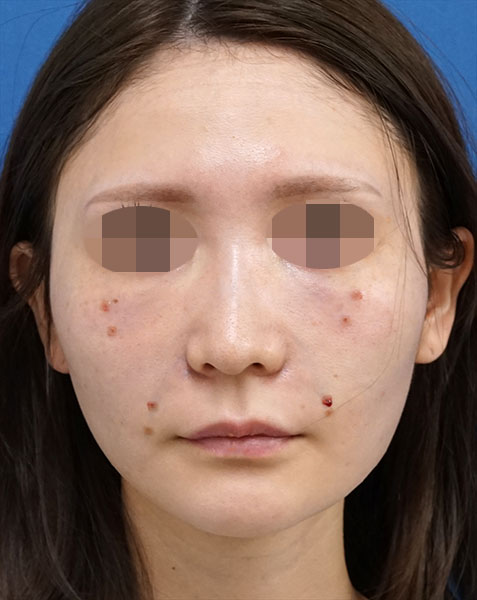 目の下くまとり手術（脂肪取り・脂肪注入）、脂肪注入（ほうれい線）　手術直後