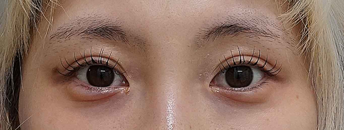 二重埋没（連結二点表止め もとびアイライト） 術後3か月のAfterの写真