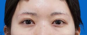  眉下切開 術後1か月