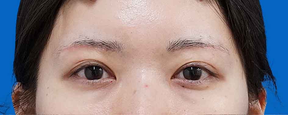 眉下切開 術後1か月のAfterの写真