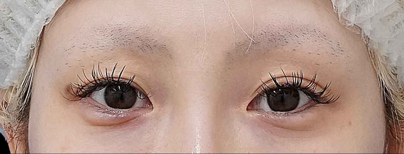 二重埋没（連結二点表止め もとびアイライト） 術後3か月のBefore写真
