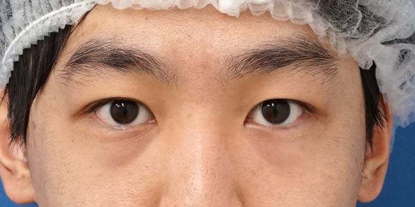 目の下くま取り（裏ハムラ法） ３ヶ月後のBefore写真