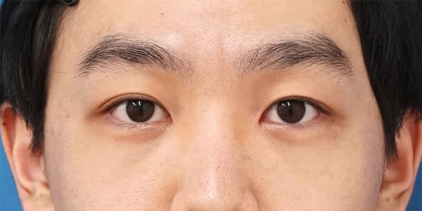 目の下くま取り（裏ハムラ法）　１ヶ月後のAfterの写真