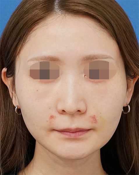 目の下くまとり手術（脂肪取り・脂肪注入）、脂肪注入（ほうれい線）　１週間後