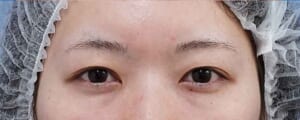 眉下切開 術前