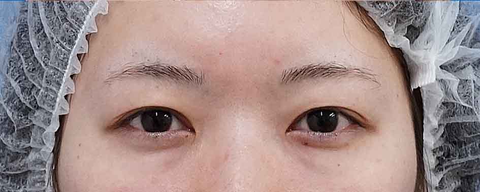 眉下切開 術後6か月のBefore写真