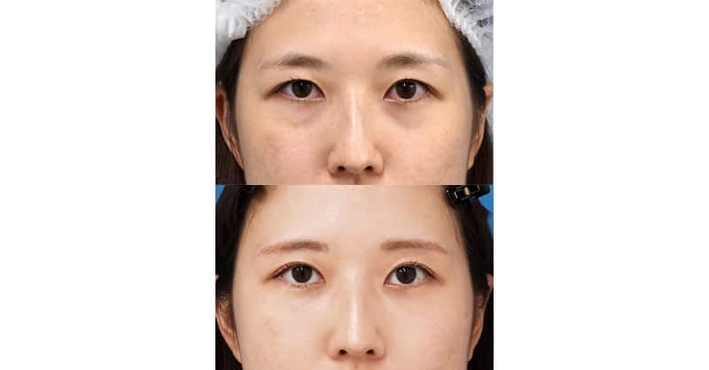 たるみとクマとりで、これだけすっきり｜眉下切開、目の下脂肪取り＋コンデンス脂肪注入　１ヶ月後