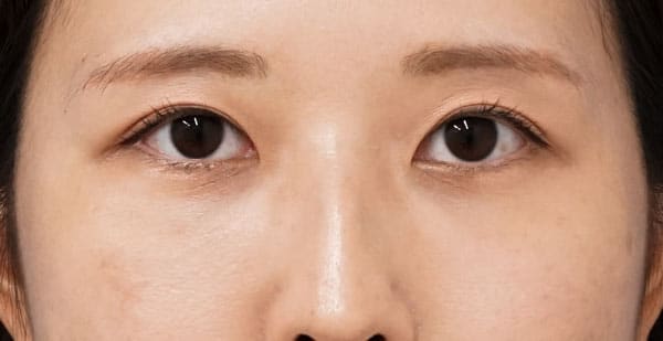眉下切開、目の下脂肪取り＋脂肪注入　１ヶ月後