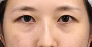 眉下切開、目の下脂肪取り＋脂肪注入　処置前