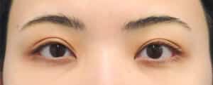 切らない眼瞼下垂、二重埋没法、切るたれ目（下眼瞼下制）　手術前