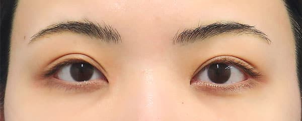 切らない眼瞼下垂、二重埋没法、切るたれ目（下眼瞼下制）　手術前