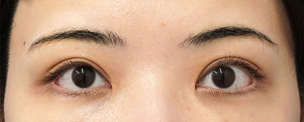 切らない眼瞼下垂、二重埋没法、切るたれ目（下眼瞼下制）　6ヶ月後