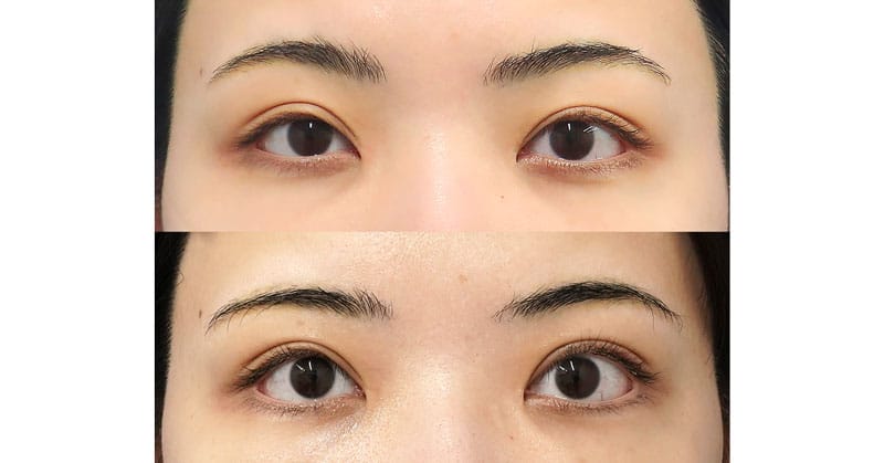 ぱっちり大きく、やさしい目元へ｜切らない眼瞼下垂プレミアム＋切るたれ目術（下眼瞼下制）６ヶ月後